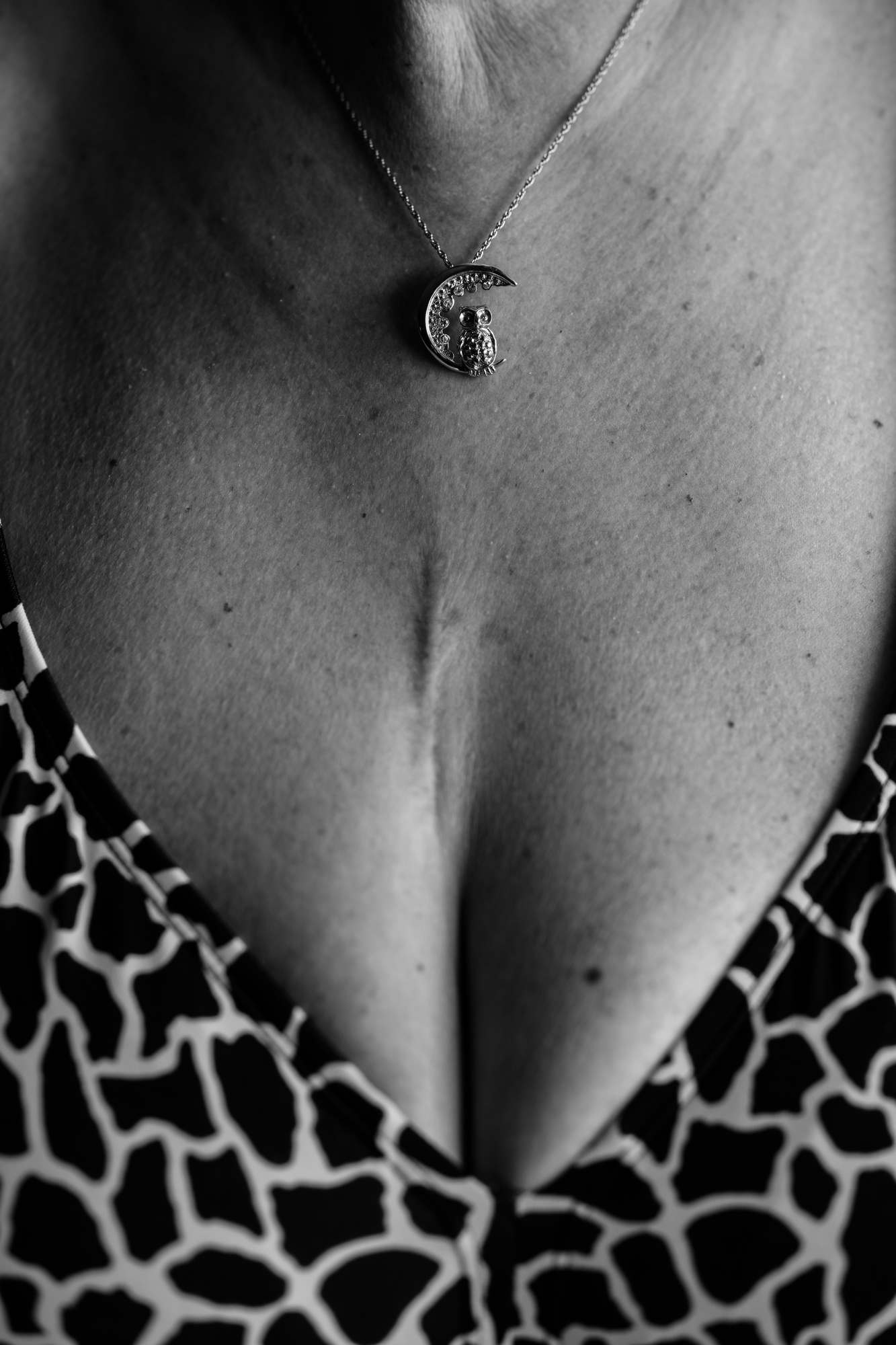 A black and white photo of a woman's chest with a moon neckalce and a scar above the cleavage