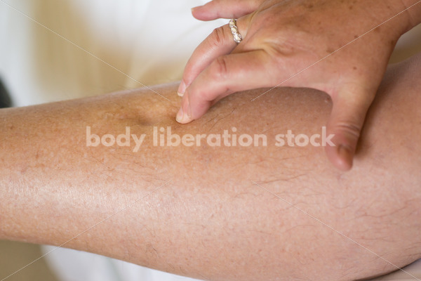 Eating Disorder Recovery Body Image Stock Photo: Pitting Edema - Body Liberation Photos