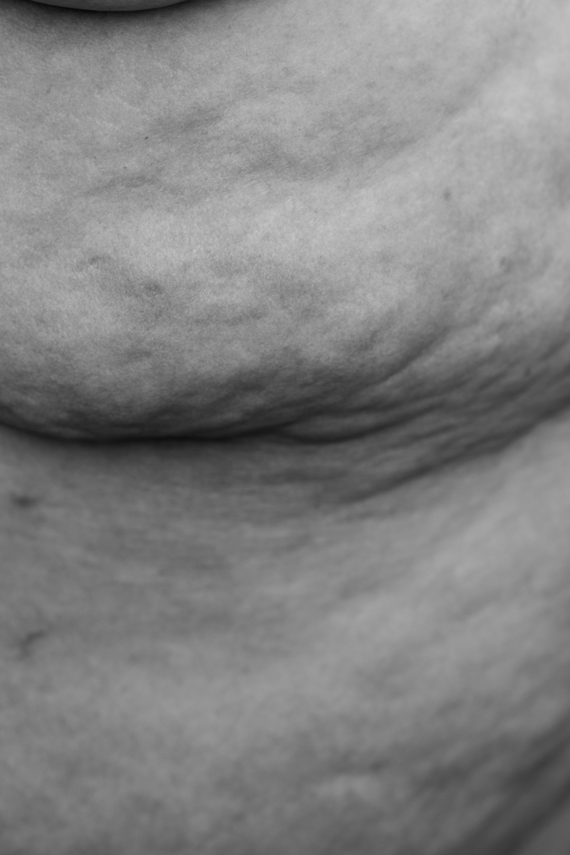 The side rolls of a fat body are show in a black-and-white photograph, with highly textured skin.