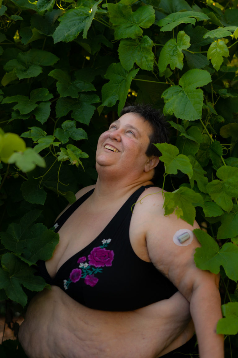 A fat white person with short brown hair, wearing a floral-print black swimsuit top with bare arms and belly, looks up smiling among grapevines with green leaves. A glucose monitor is attached to their arm.