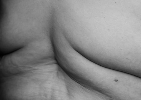 A fat woman's back is shown in black and white, with rolls, stretch marks and other skin texture.