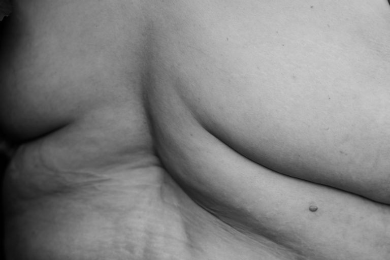 A fat woman's back is shown in black and white, with rolls, stretch marks and other skin texture.