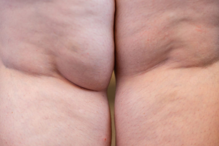 {the daily fat} Fat legs are as valuable as thin legs.