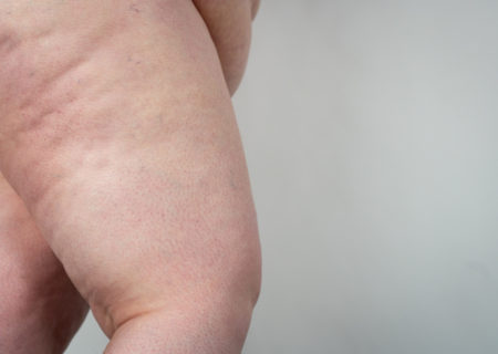A fat white woman's bare thighs against a gray background.