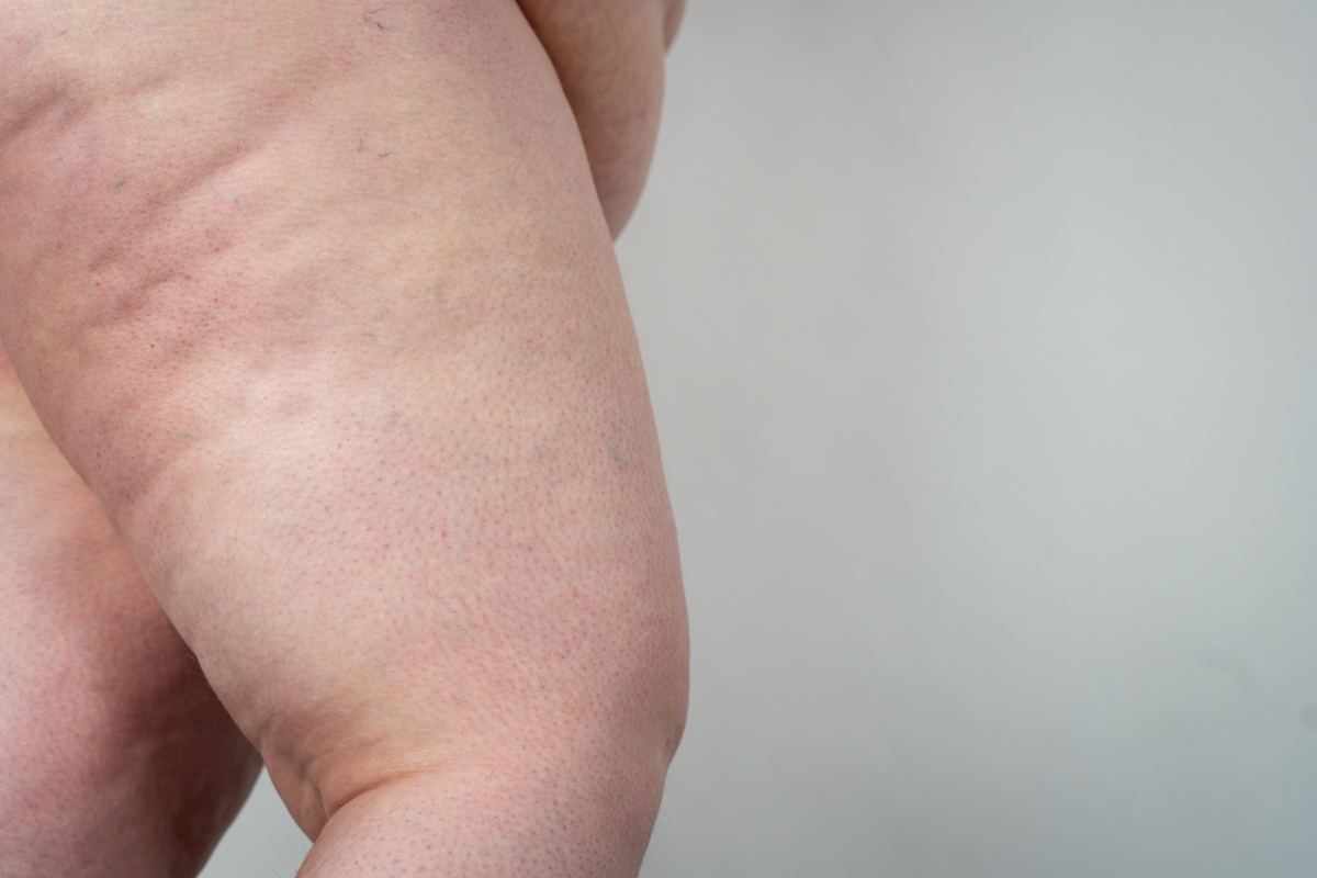 A fat white woman's bare thighs against a gray background.