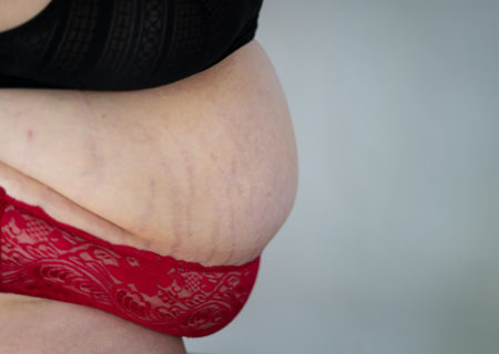 A white person's belly with stretch marks, plus partial views of their bra and panties.